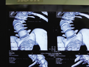小伙患病身高僅1.26米 手術后“長高”12公分(圖)