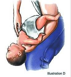 親友執(zhí)意喂食 1歲半幼女核桃仁卡住喉嚨險(xiǎn)窒息