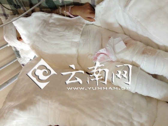云南宣威3歲女孩被燙傷續(xù)：母親放棄治療女兒