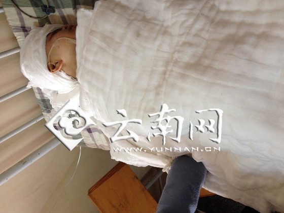 云南宣威3歲女孩被燙傷續(xù)：母親放棄治療女兒