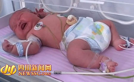 南充高齡產婦產下12.5斤重巨嬰 占滿保育箱