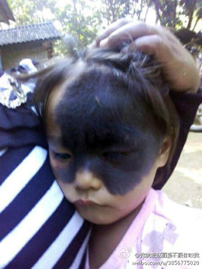 云南孟連“面具女孩”黑斑遮住半張臉 網上求助(圖)