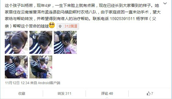 云南孟連“面具女孩”黑斑遮住半張臉 網上求助(圖)