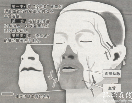 世界首例換臉手術“完美”成功(多圖)