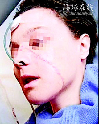 世界首例換臉手術“完美”成功(多圖)