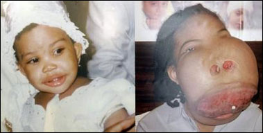 一年三度手術 海地面部畸形女孩幸獲新生
