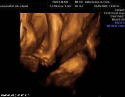 愛爾蘭連體雙胞胎成功分離 手牽手亮相溫馨感人