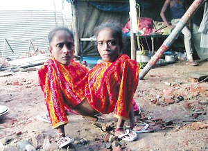 印度“蜘蛛女”拒分體 同嫁一個丈夫