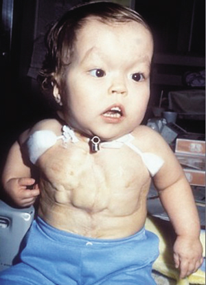 美一男子心臟掛體外存活34年(圖)