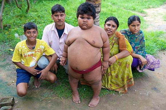 印度女孩5歲150斤醫生擔心活活吃死