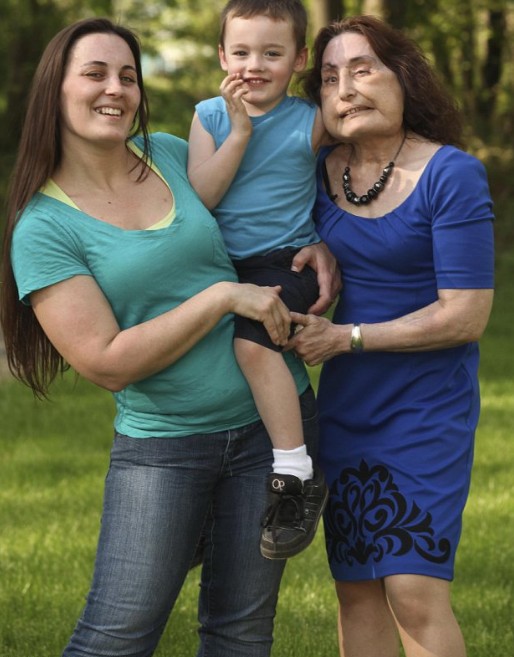 美國“換臉女”的人生奮斗 雖與兇手丈夫離婚但愛心不變