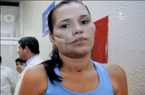 墨西哥驚現“奇跡姐” 手榴彈入臉未爆終被志愿者取出