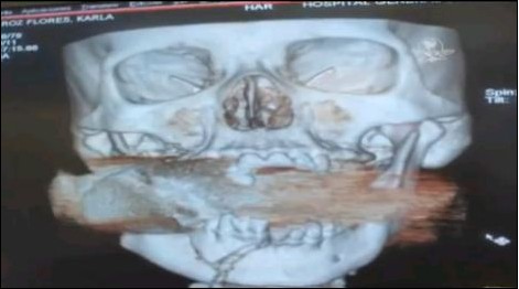 墨西哥驚現“奇跡姐” 手榴彈入臉未爆終被志愿者取出