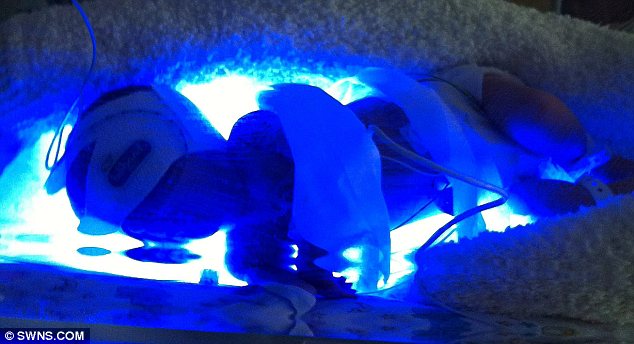 英國一新生兒體內幾乎無血 輸血后奇跡存活