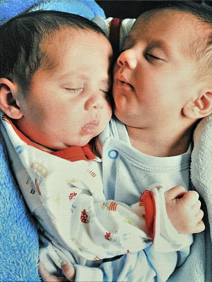 愛(ài)爾蘭連體兄弟分離后仍形影不離 睡覺(jué)都要手牽手