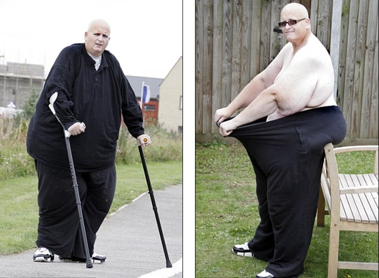 原世界最胖男子減肥后皮膚下垂 渴望切除多余皮膚