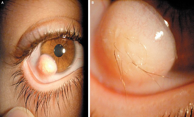 眼球上長毛發！伊朗小伙眼部奇異囊腫恐怖駭人