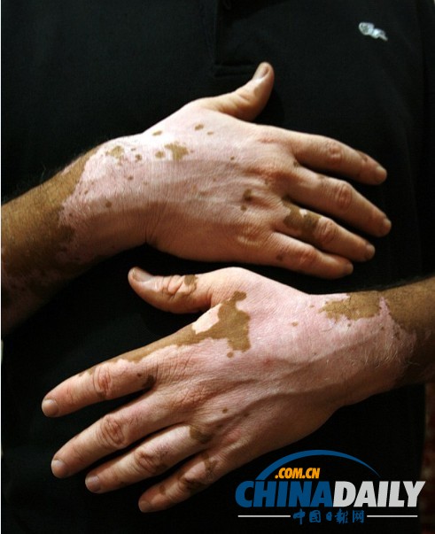 白發變黑將成真 “吸血鬼療法”有效治禿頂