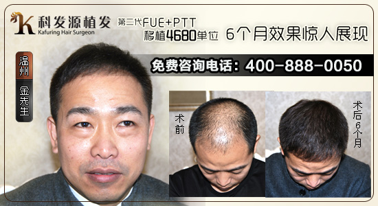 植發效果怎么樣 植發效果評估