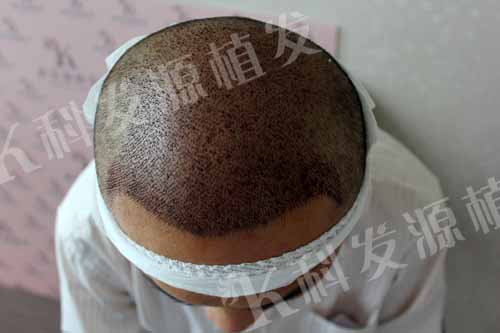 張青松：我之最 一次植發三種技術