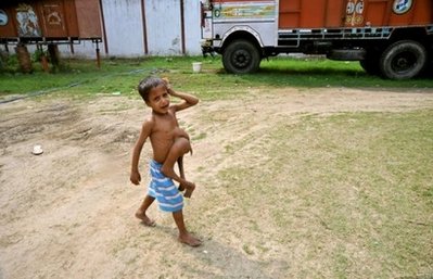 印度八肢男童希望得到手術救助[圖]