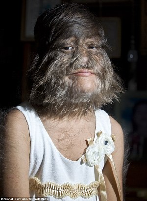 泰國女孩患罕見疾病毛發遍身 載入吉尼斯紀錄成明星