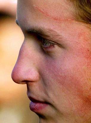 英王妃凱特曾做腦部手術(shù)？ 近8厘米傷疤清晰可見