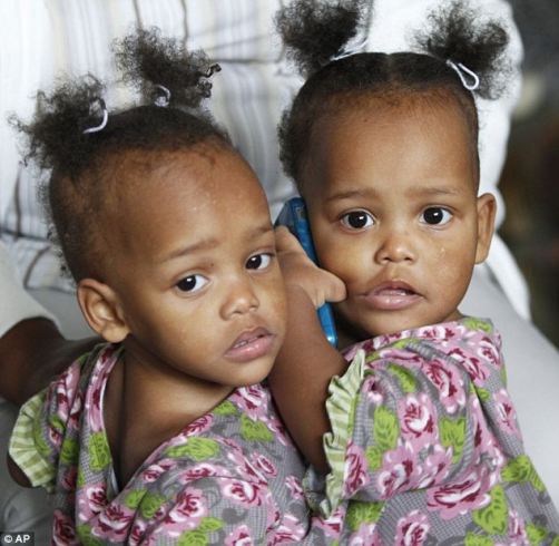 連體女嬰在美成功分離 曾共用肝臟等器官(組圖)