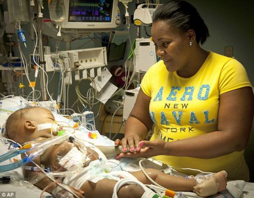 連體女嬰在美成功分離 曾共用肝臟等器官(組圖)