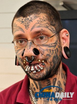 比利時(shí)女孩半邊臉文滿星星 激光治療3年徹底清除