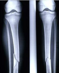 傷筋動骨一個月？ 美國“油灰”讓骨傷治療大大提速