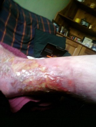 皮膚細胞也能噴涂再生？英燙傷婦女接受新療法效果神奇