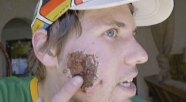 美國小伙攜女友暢游南美 不幸臉被食肉寄生蟲吃出大洞