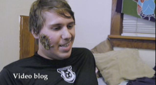 美國小伙攜女友暢游南美 不幸臉被食肉寄生蟲吃出大洞