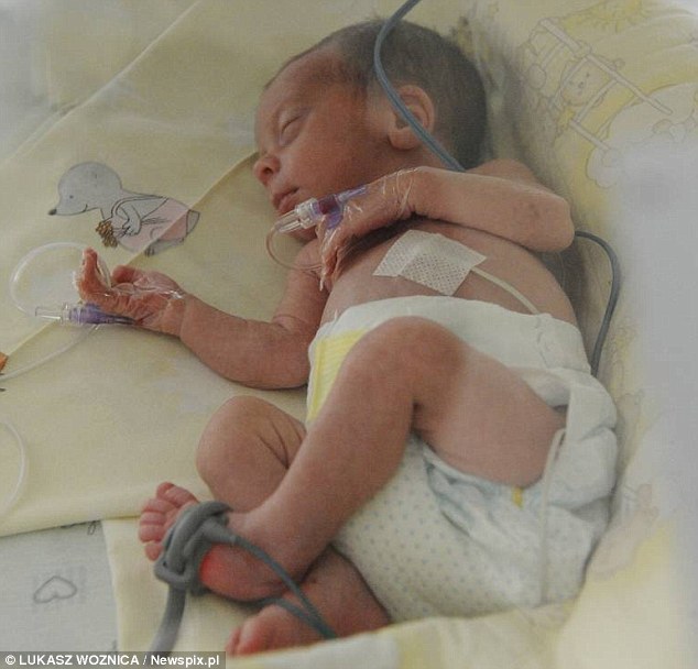 波蘭三胞胎媽媽早產(chǎn)痛失一子 為保兩胎半倒立75天