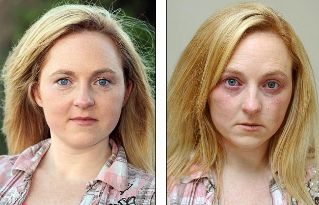 哭能致命! 英國女子皮膚對水嚴重過敏不敢流淚