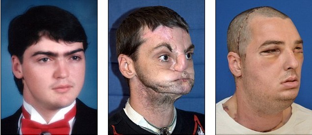 世界最大面積“換臉”手術在美完成 效果迄今為止最成功