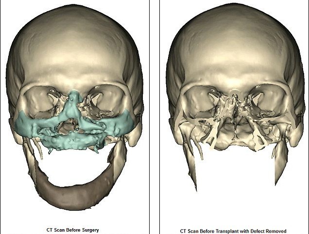 世界最大面積“換臉”手術在美完成 效果迄今為止最成功