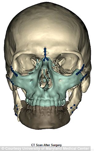 世界最大面積“換臉”手術在美完成 效果迄今為止最成功