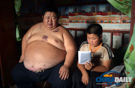 重慶最新第一胖 身高1.65米體重180公斤