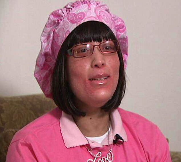 美女子全身不長毛發長指甲 屬世界首例醫學界尚無解