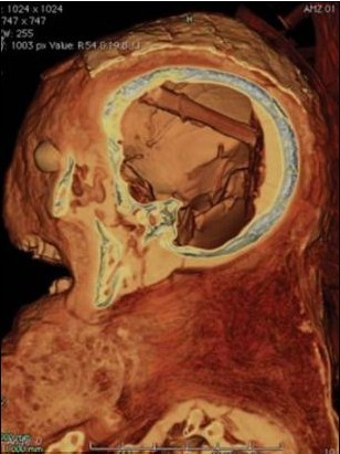 2400年前木乃伊身上驚人發現：頭顱中殘留“取腦棒”
