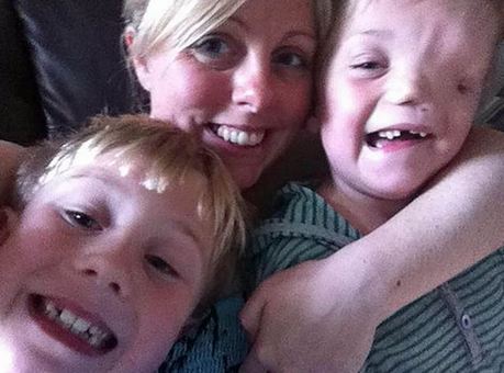 英國男童天生“半臉” 同胞兄弟情令人動容