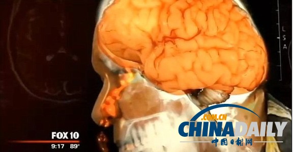 美國男子一年半鼻涕不停 竟是腦膜破洞漏腦液