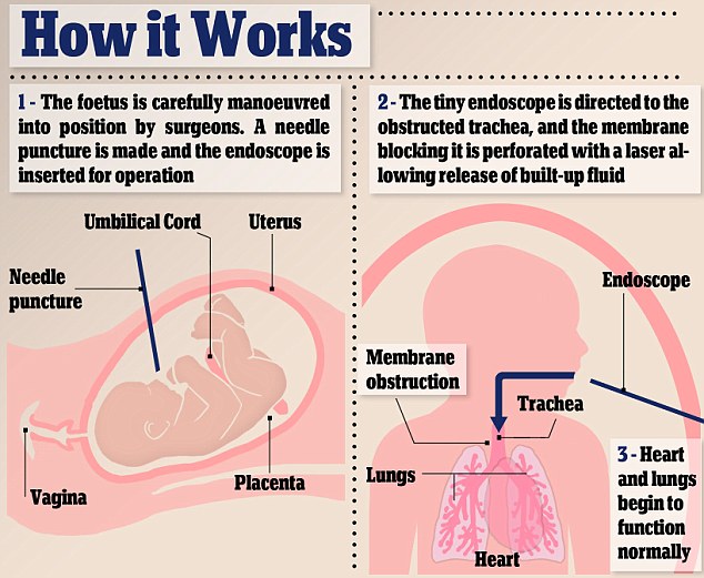 西醫生妙手回春 成功為子宮內胎兒實施氣管手術