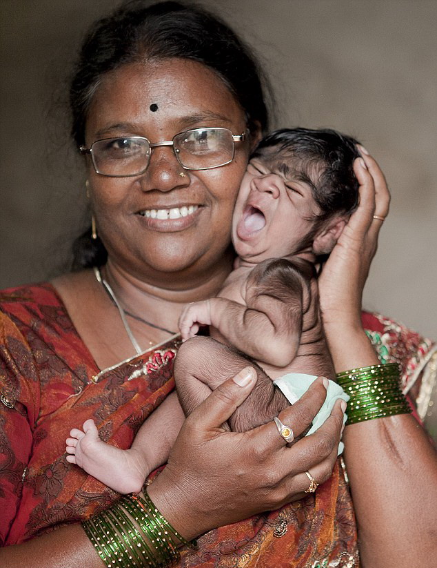 印度女嬰患罕見狼人綜合癥 全身被黑色毛發(fā)覆蓋