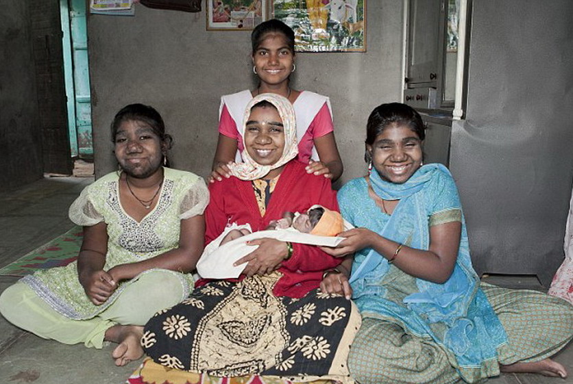 印度女嬰患罕見狼人綜合癥 全身被黑色毛發(fā)覆蓋