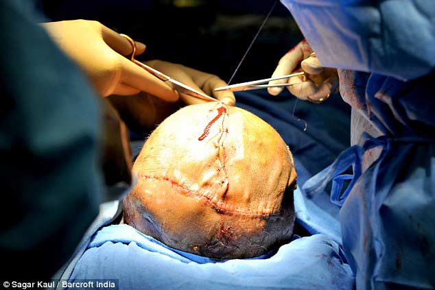 印度大頭娃娃再接受手術 醫院中度過圣誕節