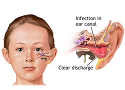 怎樣遠離“游泳耳病”