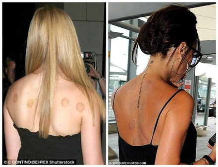 比伯新愛好:中式拔火罐